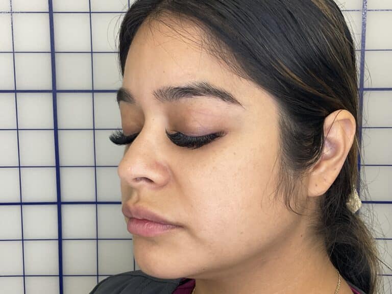 After Image: Lip Filler - left-front-oblique