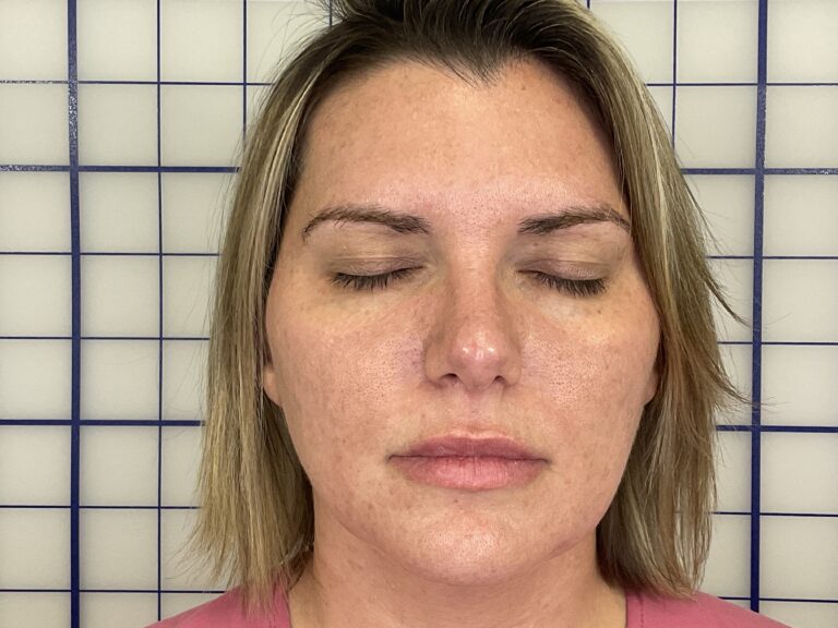 After Image: Combination Treatments - front