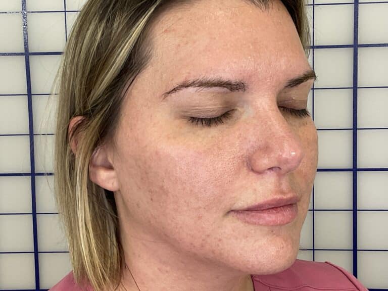 After Image: Combination Treatments - right-front-oblique