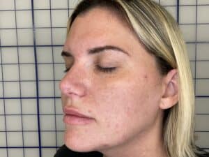 After Image: Combination Treatments