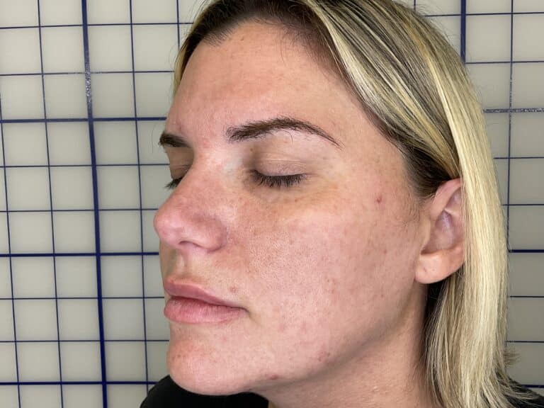 After Image: Combination Treatments - left-front-oblique