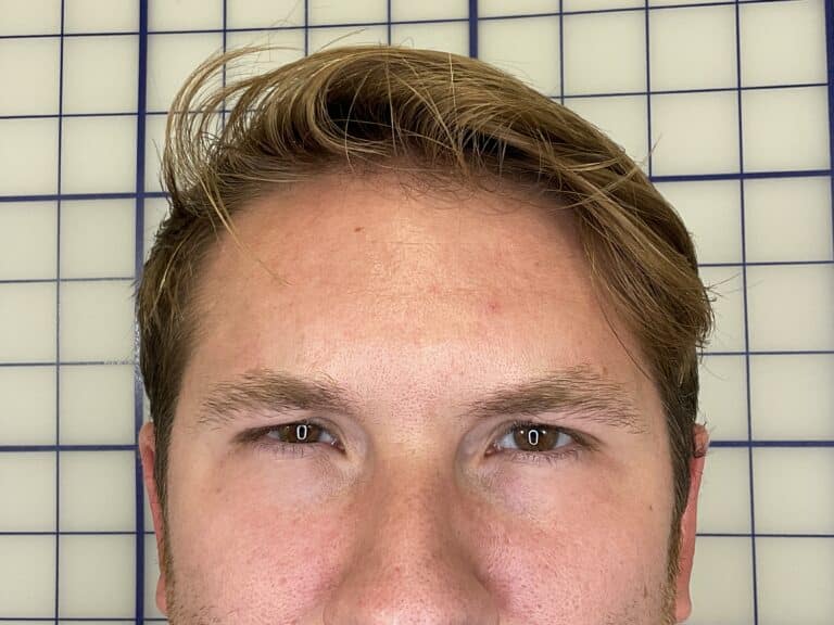 After Image: Botox - front