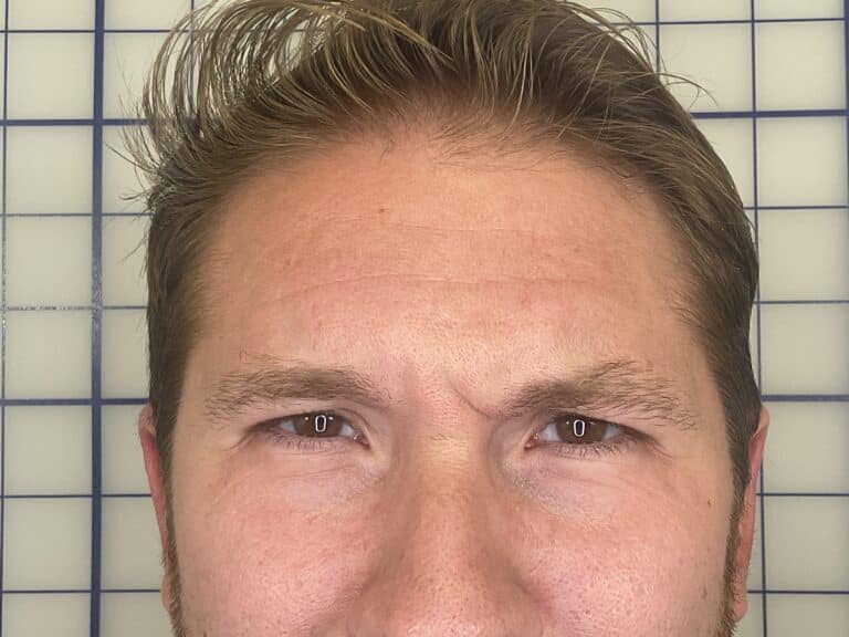 Before Image: Botox - front