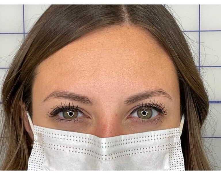 After Image: Botox - front