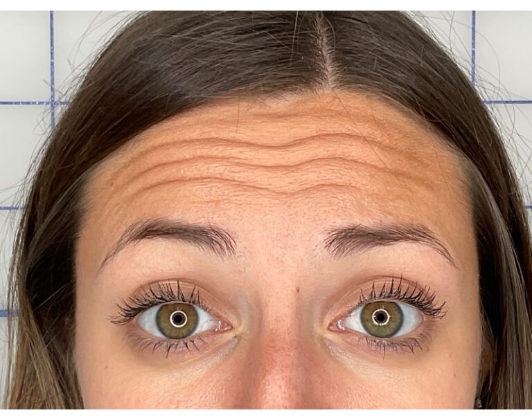 Before Image: Botox - front
