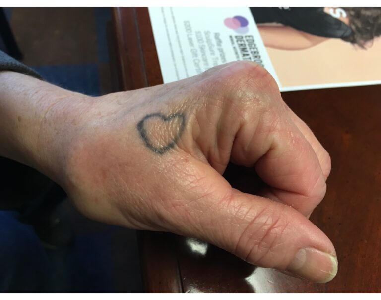 Before Image: Tattoo Removal - front