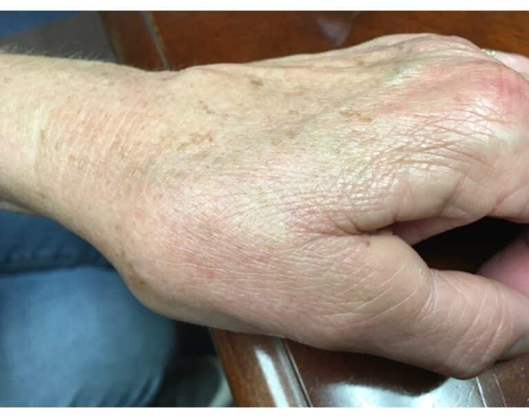 After Image: Tattoo Removal - front