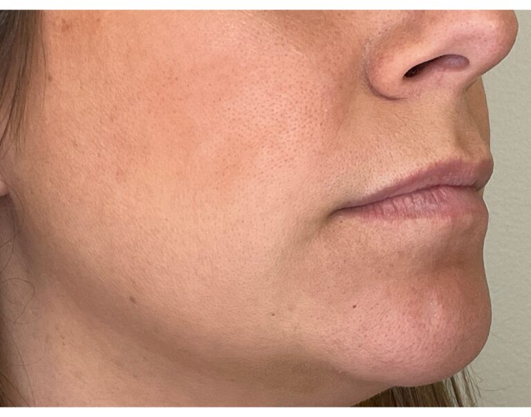 Before Image: Lip Filler - right-front-oblique