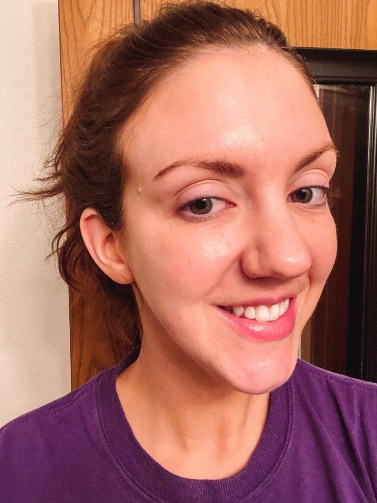 After Image: Lip Flip & Filler - front