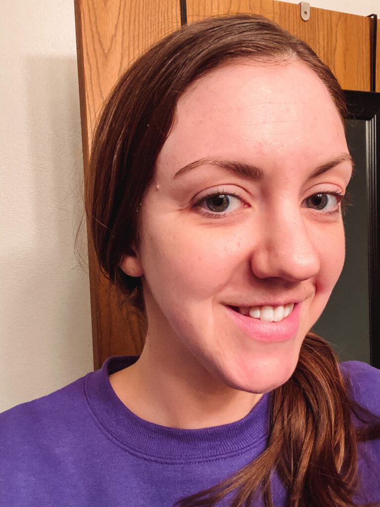 Before Image: Lip Flip & Filler - front
