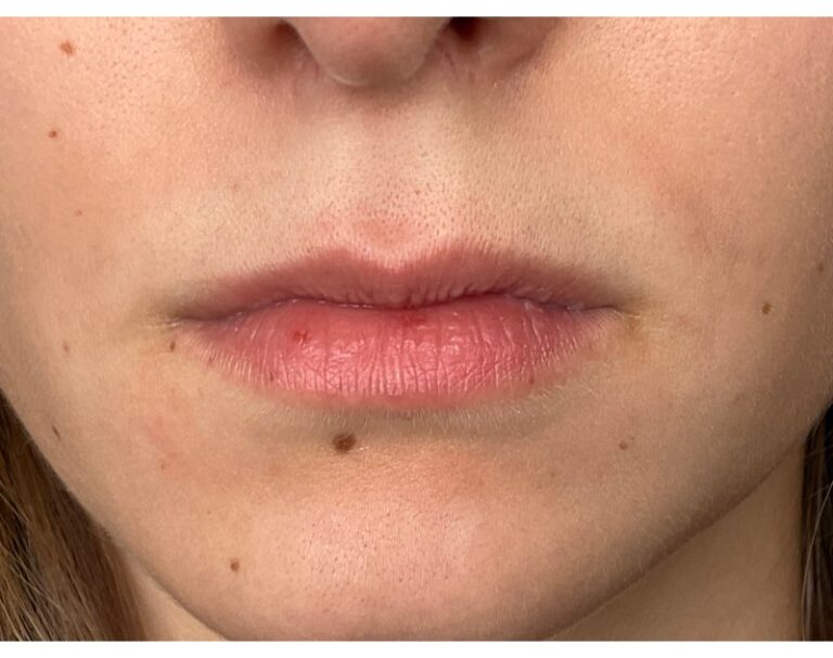 Before Image: Lip Filler - front