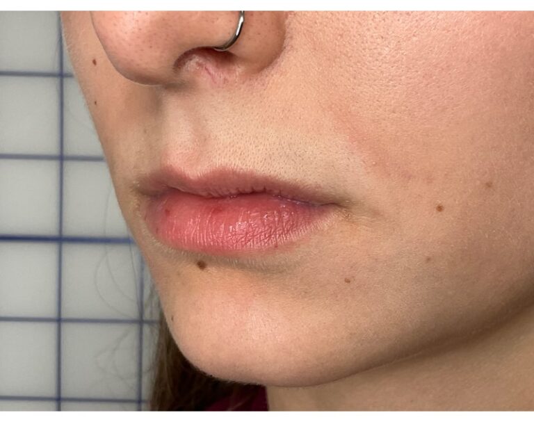 Before Image: Lip Filler - left-front-oblique