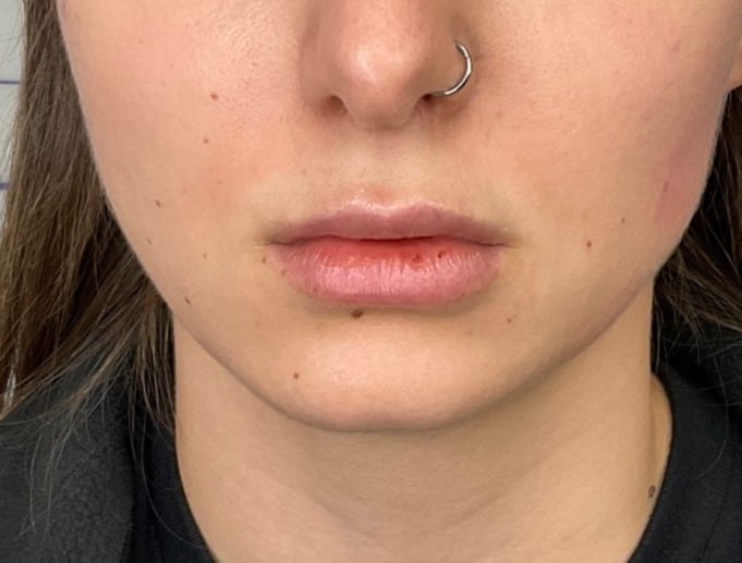 After Image: Lip Filler - front