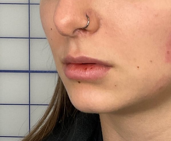 After Image: Lip Filler - left-front-oblique