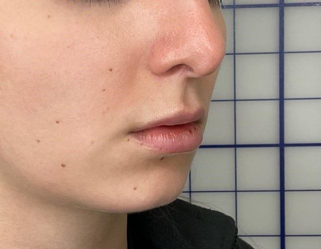 After Image: Lip Filler - right-front-oblique