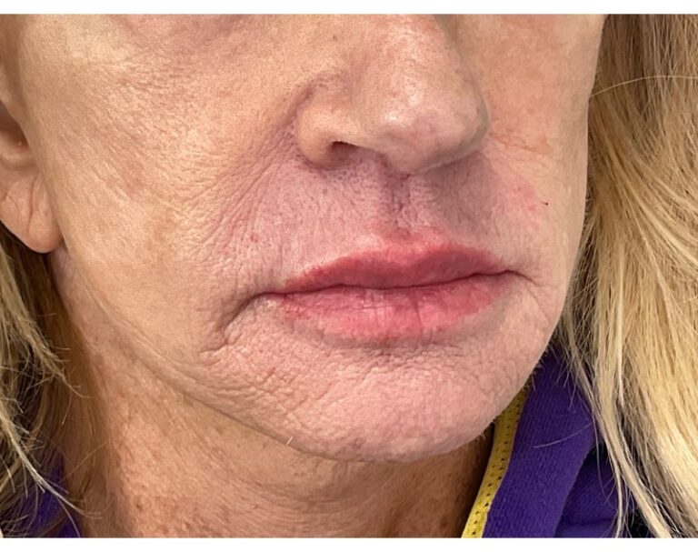 After Image: Lip Filler - right-front-oblique