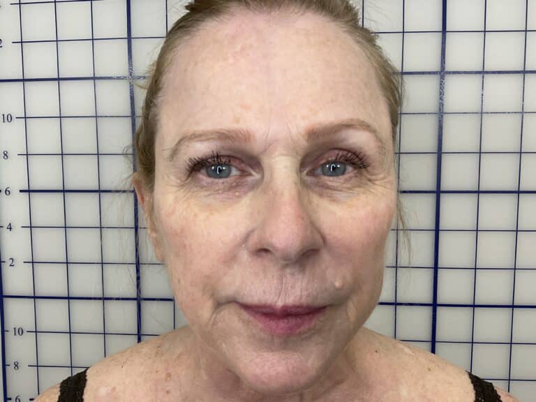 Before Image: Smile Line Filler - front