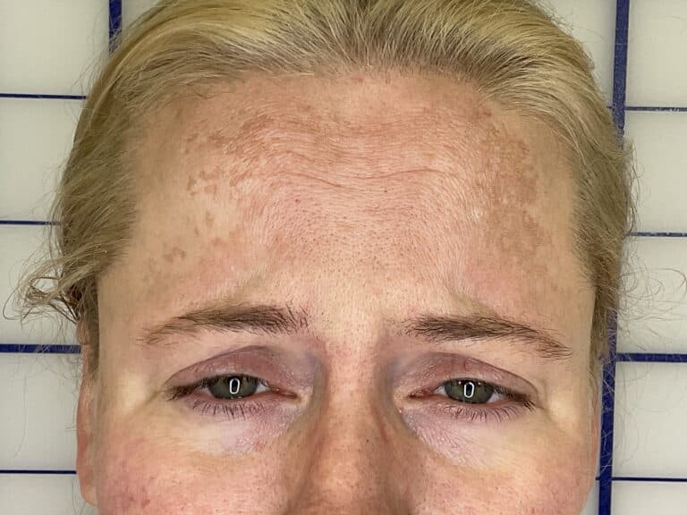 Before Image: Botox - front
