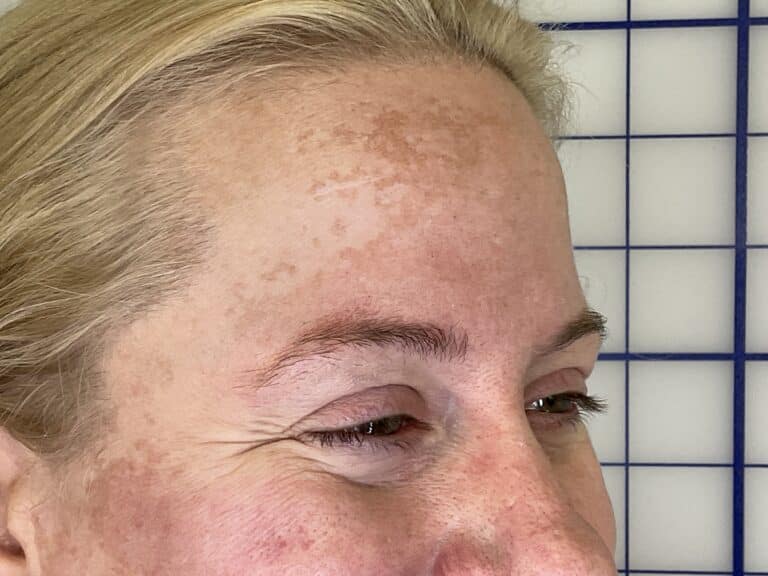 Before Image: Botox -