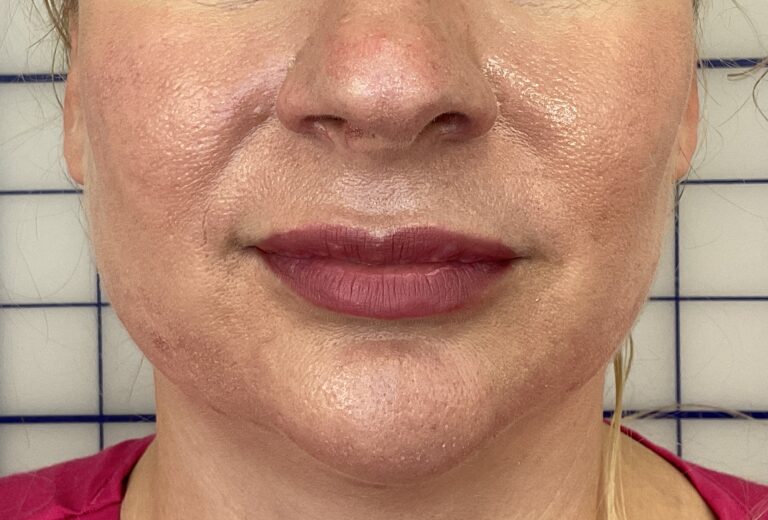 Before Image: Smile Line Filler -