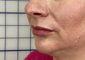 Smile Line Filler