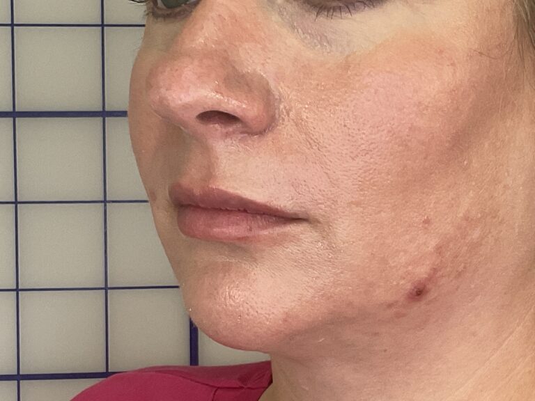 After Image: Smile Line Filler - left-front-oblique