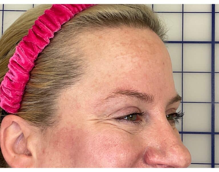 After Image: Botox -