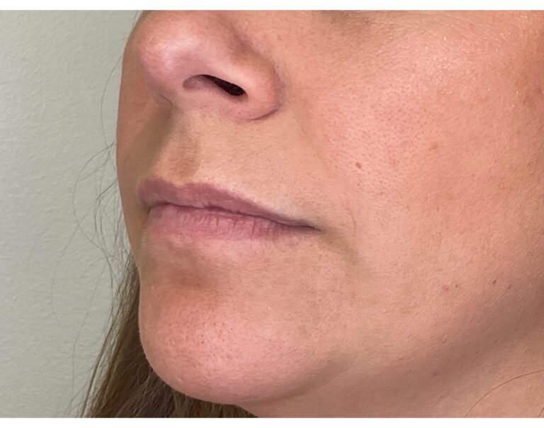 Before Image: Lip Filler - left-front-oblique