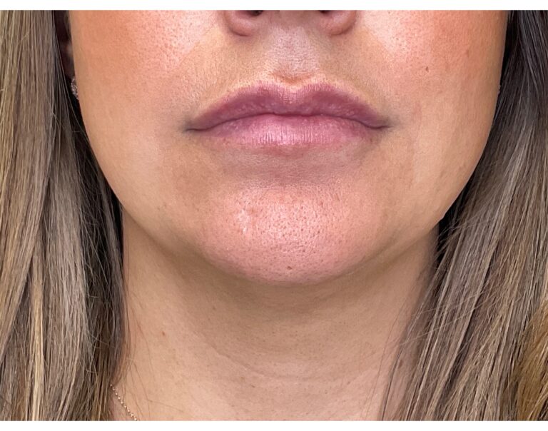 After Image: Lip Filler - front