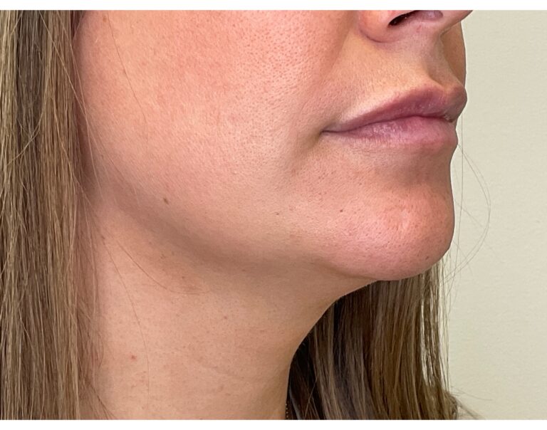 After Image: Lip Filler - right-front-oblique