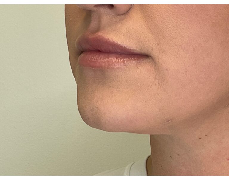 After Image: Lip Filler - left-front-oblique