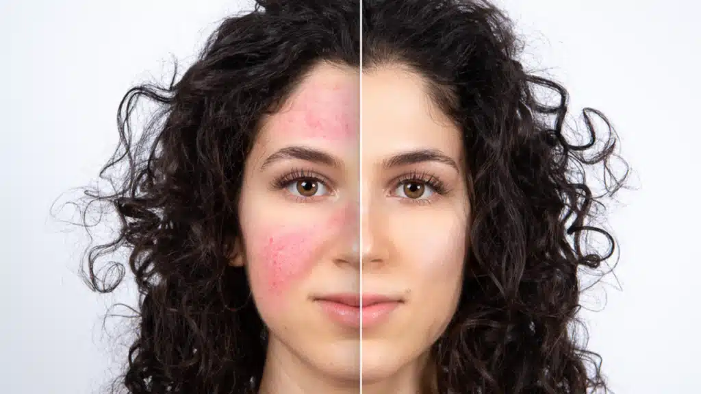 42485229 Rosacea 1