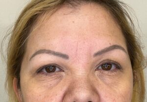 After Image: Botox