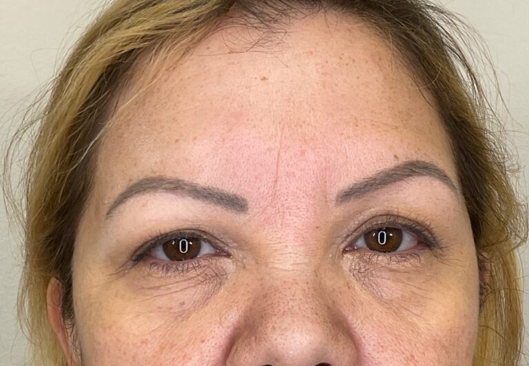 After Image: Botox - front