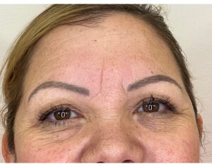 Before Image: Botox