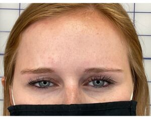 Botox