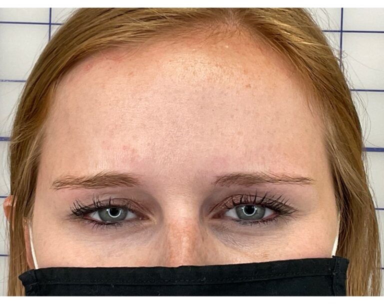 After Image: Botox - front