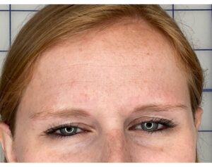 Botox