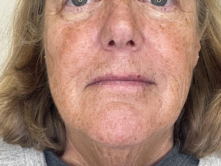 After Image: Filler: Cheeks & Nasolabial Folds (NLF) - front