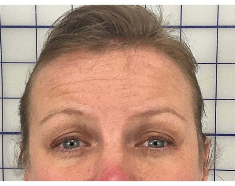 After Image: Botox - front