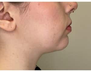 Chin Augmentation