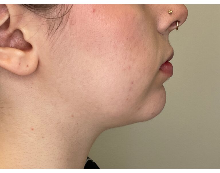 After Image: Chin Augmentation - right-side