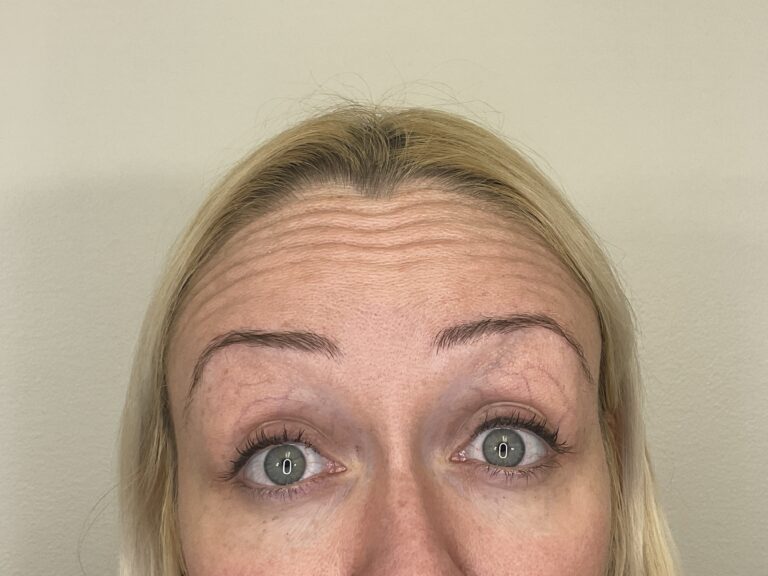 Before Image: Botox - front