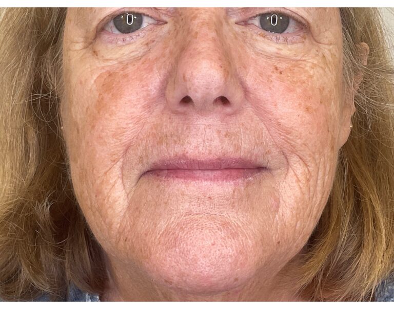 Before Image: Filler: Cheeks & Nasolabial Folds (NLF) - front