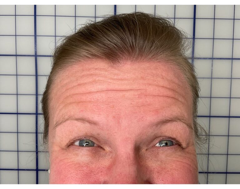 Before Image: Botox - front