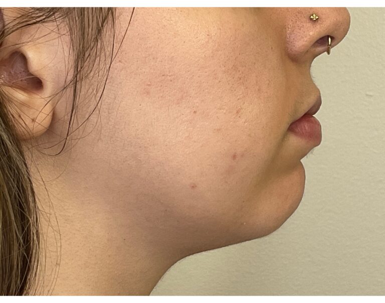 Before Image: Chin Augmentation - right-side