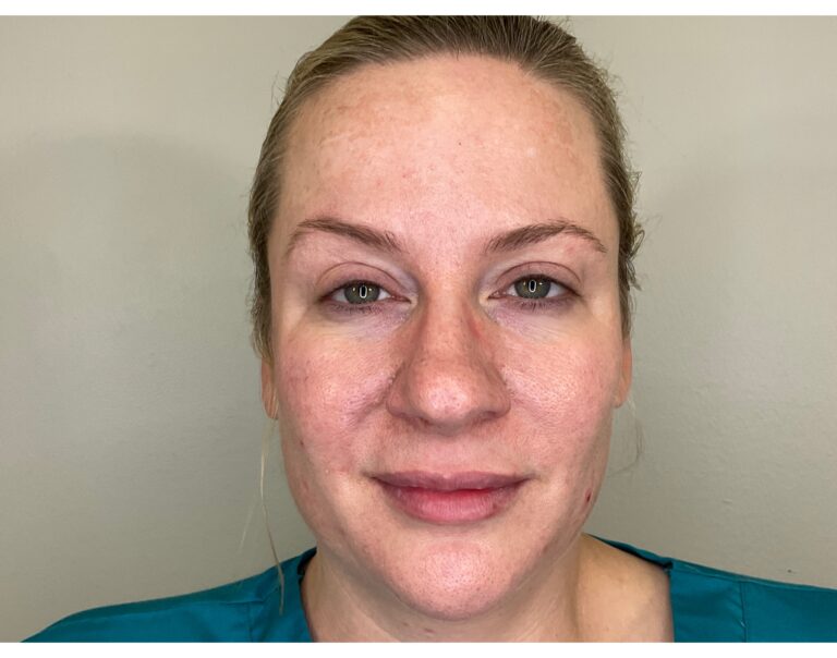 Before Image: Cheek Filler - front