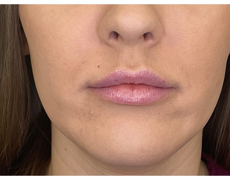 Before Image: Lip Filler - front