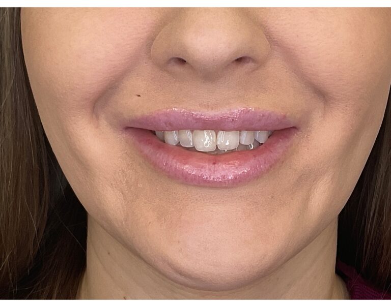 Before Image: Lip Filler - front