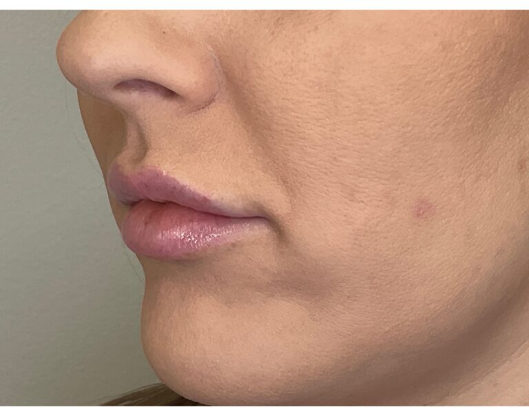 Before Image: Lip Filler - left-front-oblique